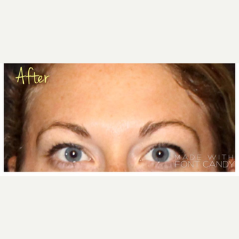 25-34 year old woman treated with Ultherapy after 3424005