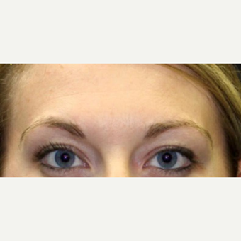 25-34 year old woman treated with Ultherapy before 3424005