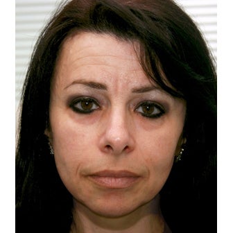 Voluma, cheeks and lower lids before 1722982