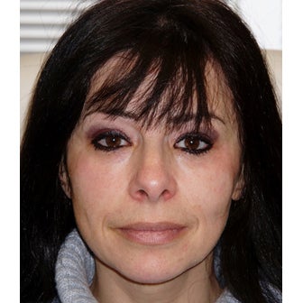 Voluma, cheeks and lower lids after 1722982