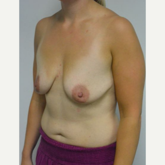 25-34 year old woman treated with Breast Lift with Implants before 3219898