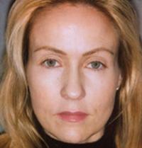 Botox before 905112