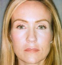 Botox after 905112