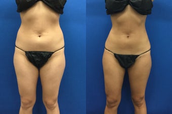 25-34 year old woman treated with Liposculpture before 3142357
