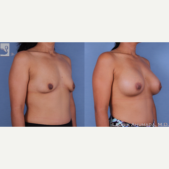 35-44 year old woman treated with Breast Augmentation 3093363