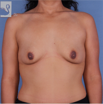 35-44 year old woman treated with Breast Augmentation before 3093363