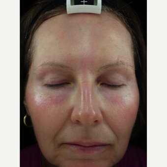 55-64 year old woman treated with CO2 Laser after 2830430