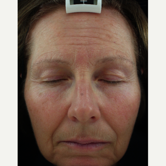 55-64 year old woman treated with CO2 Laser before 2830430