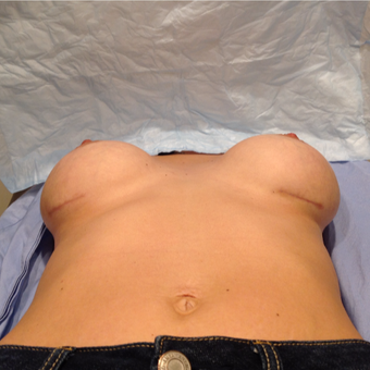 25-34 year old woman treated with Breast Implant Revision after 3075224