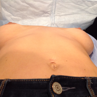 25-34 year old woman treated with Breast Implant Revision before 3075224