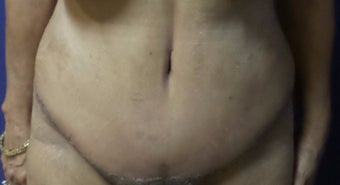 65-74 year old woman treated with Tummy Tuck after 3195968