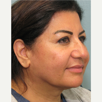 35-44 year old woman treated with Smart Lipo after 3143187