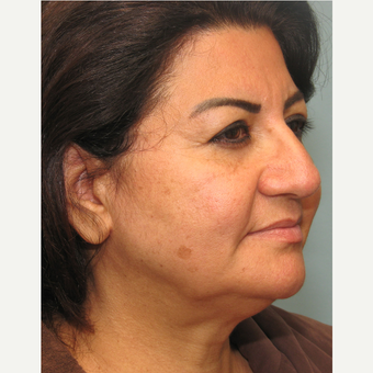 35-44 year old woman treated with Smart Lipo before 3143187