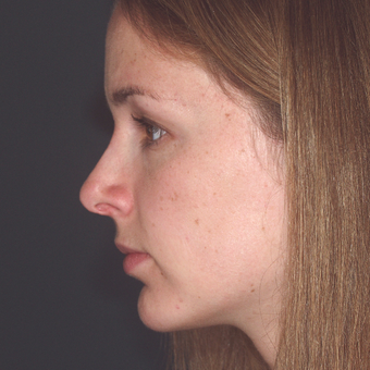 The woman did not like the projection of her nose. Nasal projection looks worse due to a weak chin after 3679399