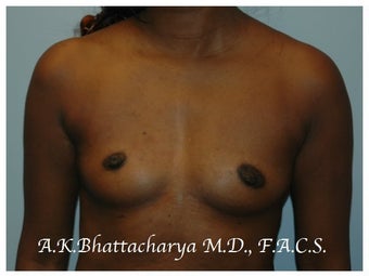 38 year old woman treated with Breast Augmentation before 3103110