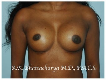 38 year old woman treated with Breast Augmentation after 3103110