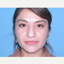 25-34 year old woman treated with Rhinoplasty before 3742982