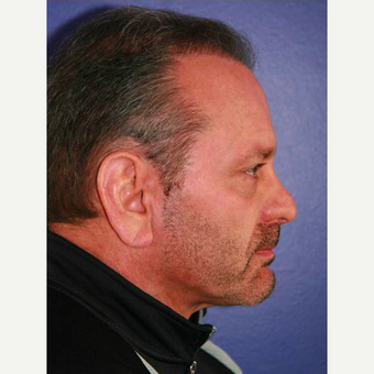 64 year old man treated with Facelift before 3710826