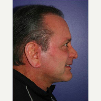 64 year old man treated with Facelift after 3710826