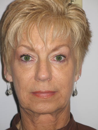 62 Year Old Woman with Mini-Facelift before 903466