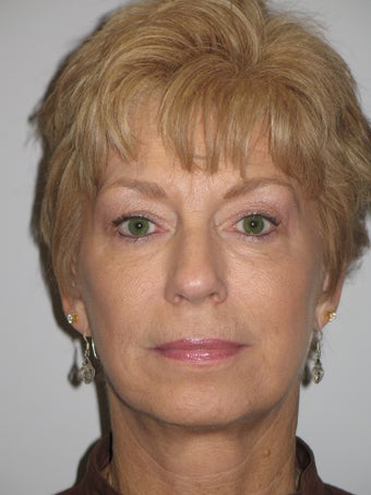 62 Year Old Woman with Mini-Facelift after 903466