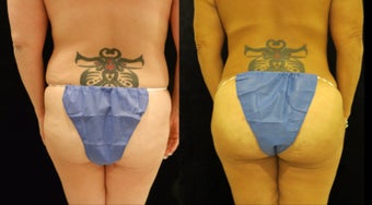 Liposuction of the back with fat transfer to buttocks before 3405374