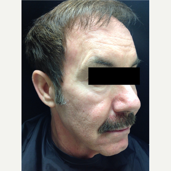 55-64 year old man treated with Voluma before 3784412