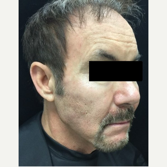 55-64 year old man treated with Voluma after 3784412