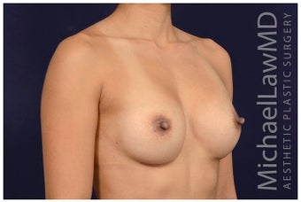 25-34 year old woman treated with Sientra Breast Implants after 1676547