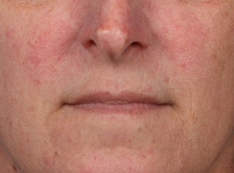 45-54 year old woman treated with Lip Augmentation before 3006026