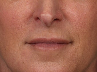 45-54 year old woman treated with Lip Augmentation after 3006026