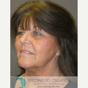 65-74 year old woman treated with Laser Treatment before 2759292