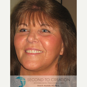 65-74 year old woman treated with Laser Treatment after 2759292