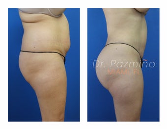35-44 year old woman treated with Brazilian Butt Lift before 1675739