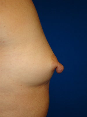 Nipple Reduction / Breast Augmentation before 1123471
