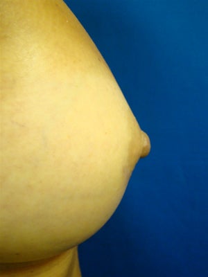 Nipple Reduction / Breast Augmentation after 1123471