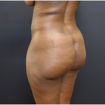 35-44 year old woman treated with Brazilian Butt Lift before 3200898