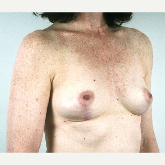 45-54 year old woman treated with Breast Implant Removal and Mastopexy after 1815474