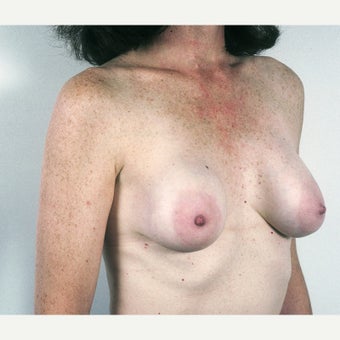 45-54 year old woman treated with Breast Implant Removal and Mastopexy before 1815474