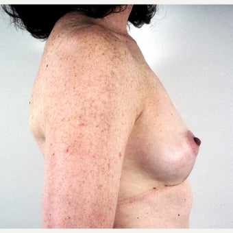 45-54 year old woman treated with Breast Implant Removal and Mastopexy 1815474