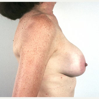 45-54 year old woman treated with Breast Implant Removal and Mastopexy 1815474