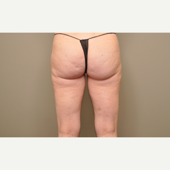 35-44 year old woman treated with Cellfina before 3453617