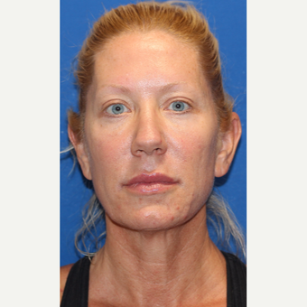 45-54 year old woman treated with Facelift before 3665697