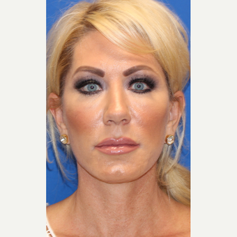 45-54 year old woman treated with Facelift after 3665697