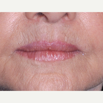 65-74 year old woman treated with Lip Lift after 3668683