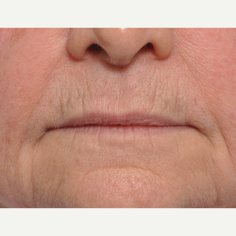 65-74 year old woman treated with Lip Lift before 3668683