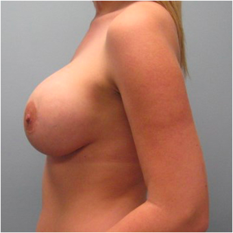 22 year old woman treated with Ideal Implant after 3468825