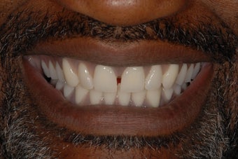This male patient had replacement of all his teeth with full denture in the top jaw and implant bridge in the bottom jaw. after 1029411