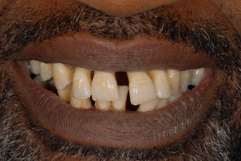 This male patient had replacement of all his teeth with full denture in the top jaw and implant bridge in the bottom jaw. before 1029411