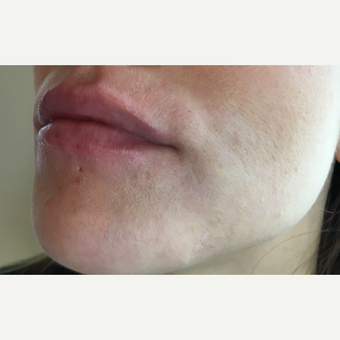 Juvederm Ultra treatment for this 32 year old woman after 3163418